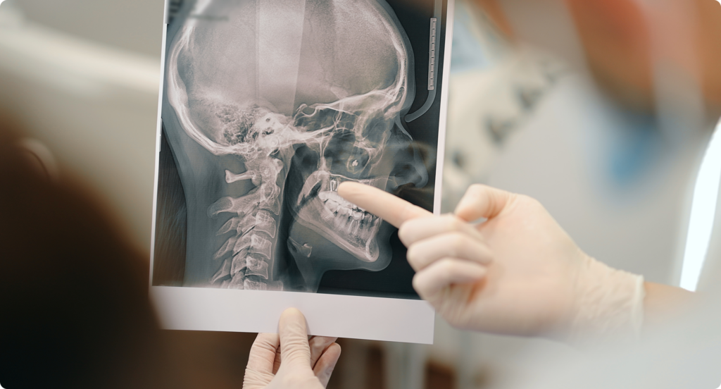 Dentist reviewing a patient's skull and jaw X-ray while pointing to the teeth and explaining the diagnosis and recommended oral surgery treatment.